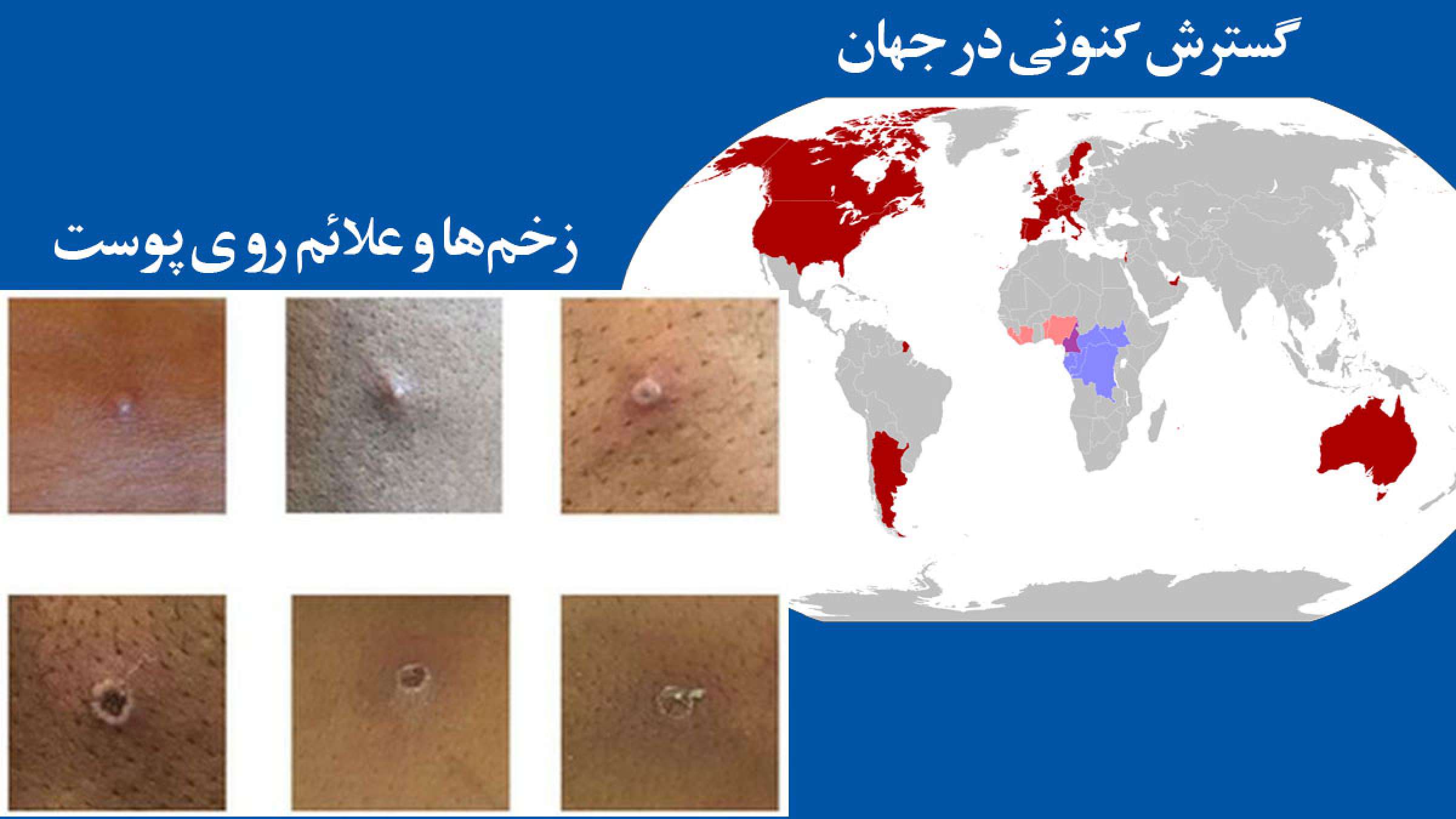 خبر-پزشکی-کانادا-آبله-میمونی-استان-کانادا-۴-روز-۳-برابر-آبله-میمونی-بدانید