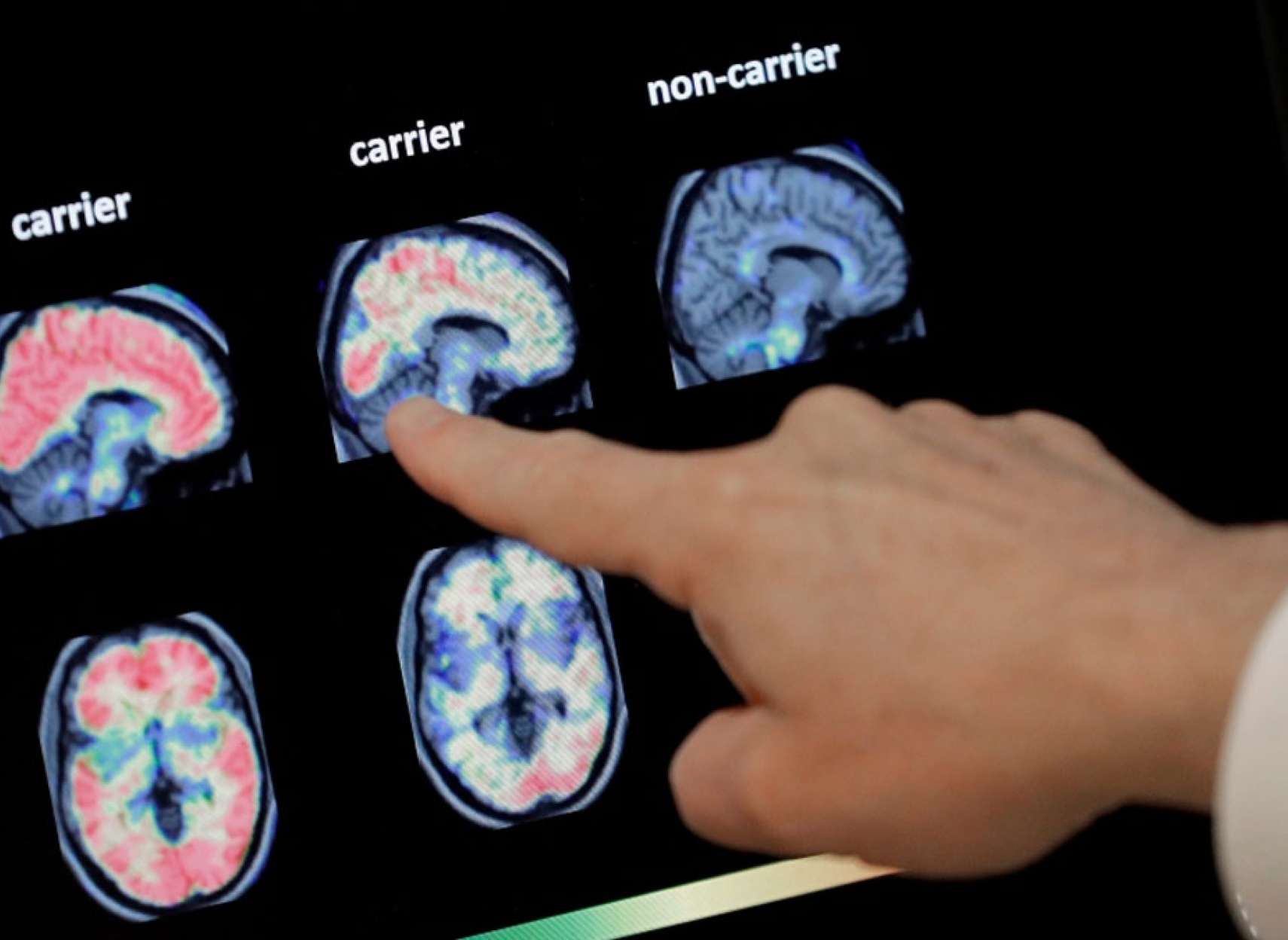 خبر-علمی-روش-تشخیص-جدید-بیماری-آلزایمر-با-دقتی-بیشتر-از-۹۰-درصد-هوش-مصنوعی