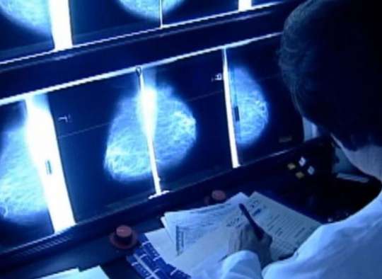 علمی-محققان-کانادایی-سن-غربالگری-سرطان-پستان-۵۰-سالگی-به-۴۰-کاهش-یابد
